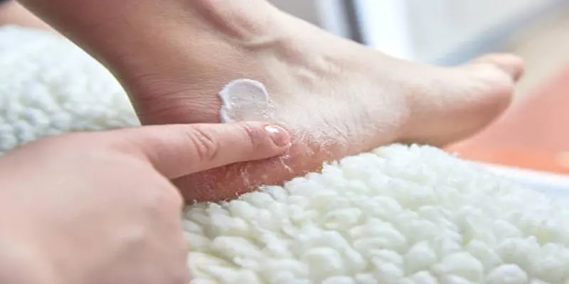 Effective Treatments for Dry and Cracked Skin on Hands and Feet